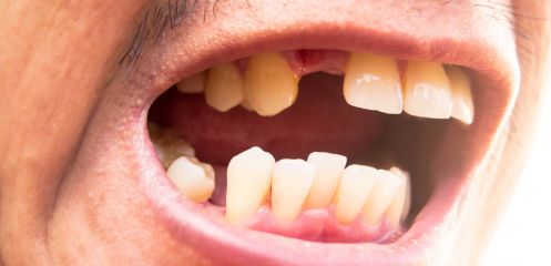 Multiple missing teeth across the arch